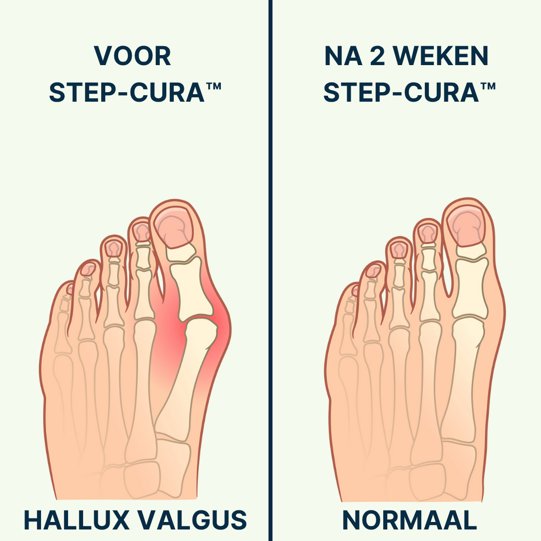 Step-Cura™ Comfort Brace